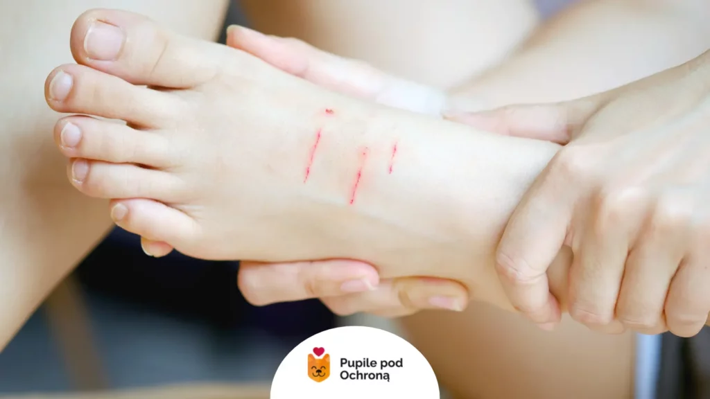 Zadrapanie na stopie człowieka. Choroba kociego pazura przenosi się na ludzi przez zadrapanie lub ugryzienie.